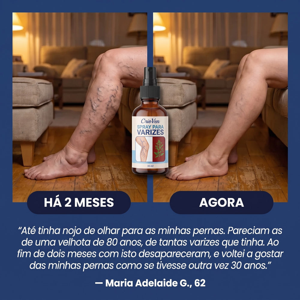 Antes e depois: pernas com varizes há 2 meses e agora com o spray CrioVen