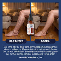 Antes e depois: pernas com varizes há 2 meses e agora com o spray CrioVen