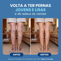 Antes e depois das varizes nas pernas