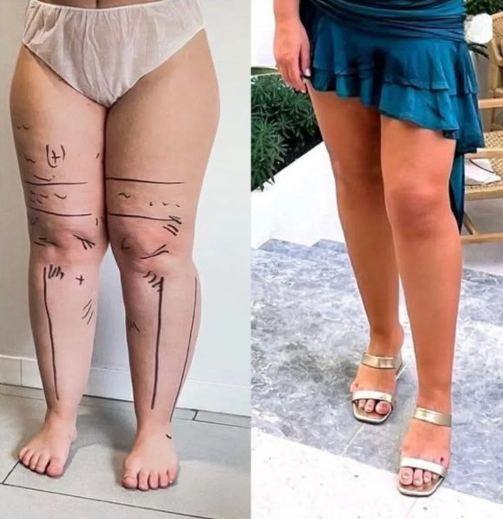 Pernas antes e depois
